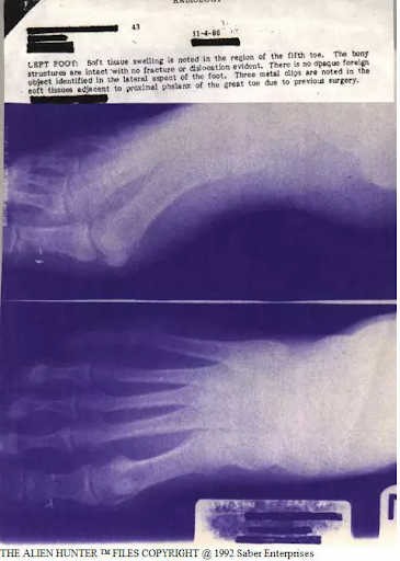Xrays of Patricias implants